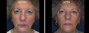 anti-aging | Skin Rejuvenation