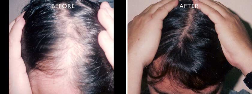 , Hair Loss for Men &amp; Women