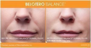 BELOTERO BALANCE® Full Front Dermal Filler