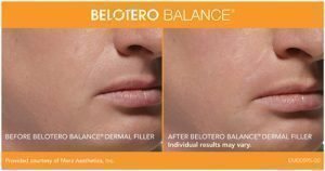BELOTERO BALANCE® Full Front Dermal Filler