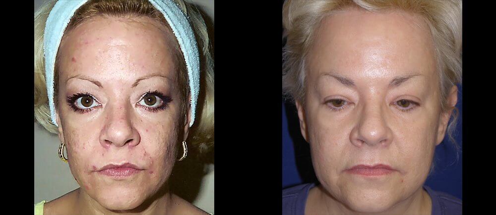 , Acne Patient Before and After Gallery