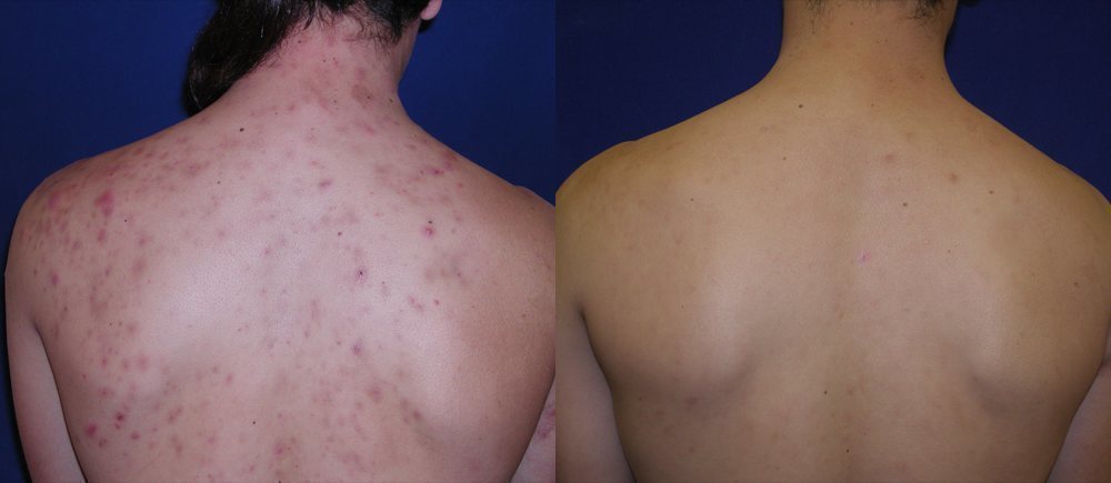 , Acne Patient Before and After Gallery