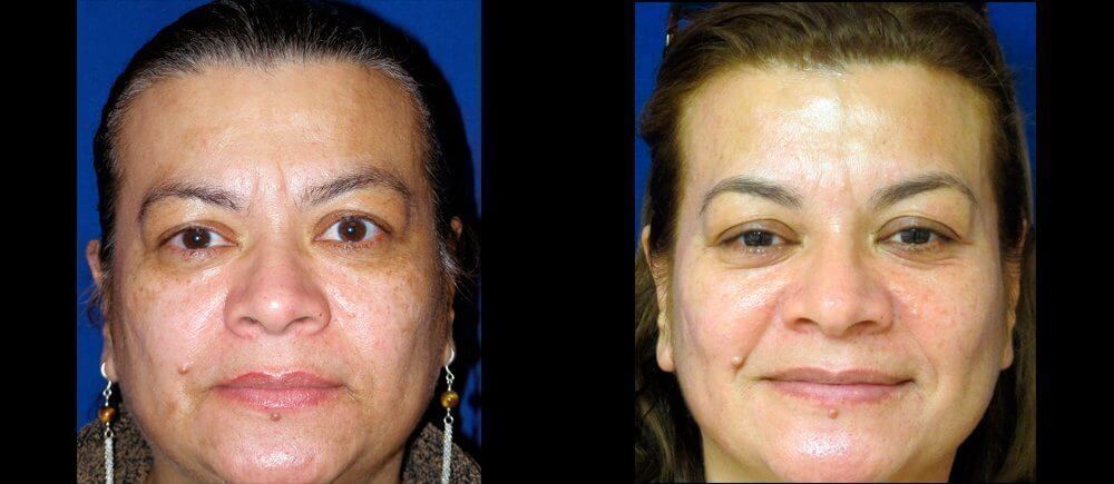 , Botox Patient Before and After Gallery