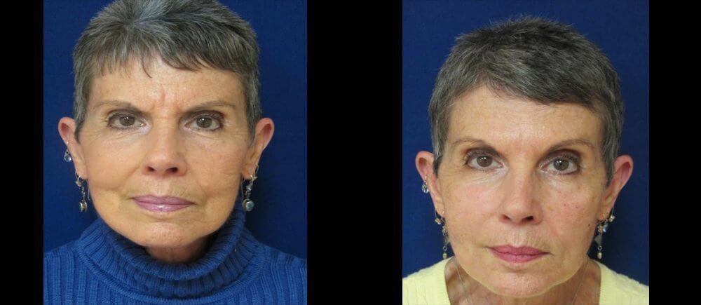 , Botox Patient Before and After Gallery