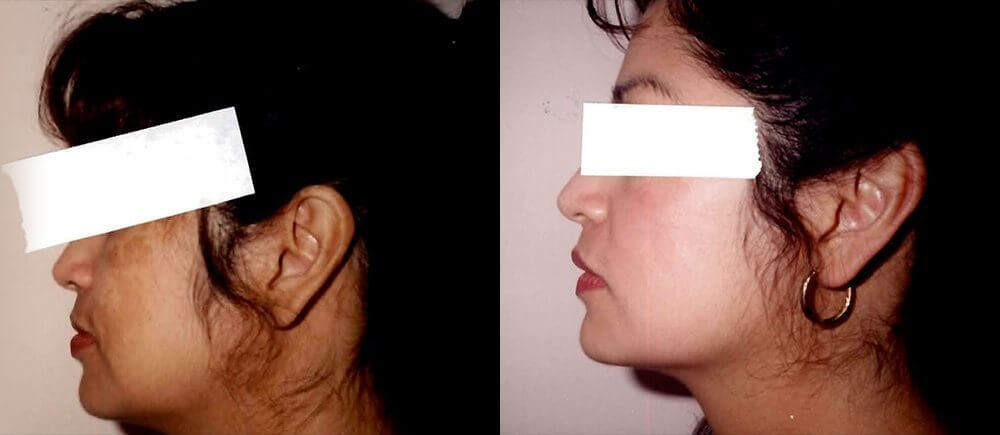 , Brown Spots &amp; Melasma Patient Before and After Gallery
