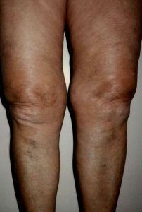 , Leg Veins Patient Before and After Gallery