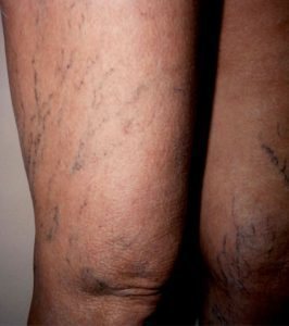 , Leg Veins Patient Before and After Gallery