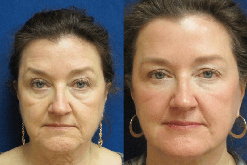 , Xeomin Patient Before and After Gallery