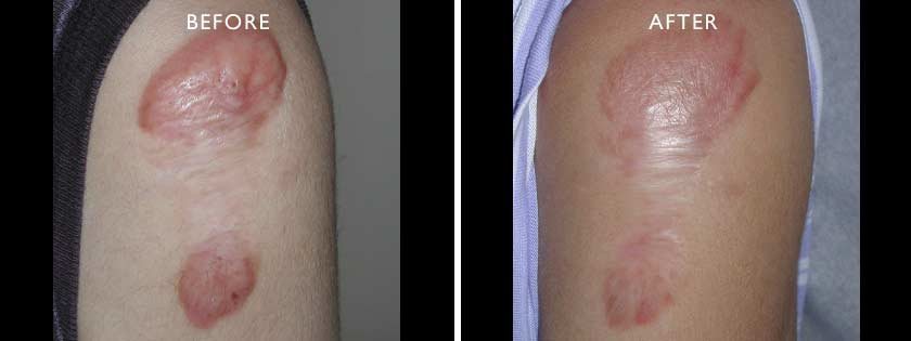 , Smoothbeam LASER Patient Before and After Gallery