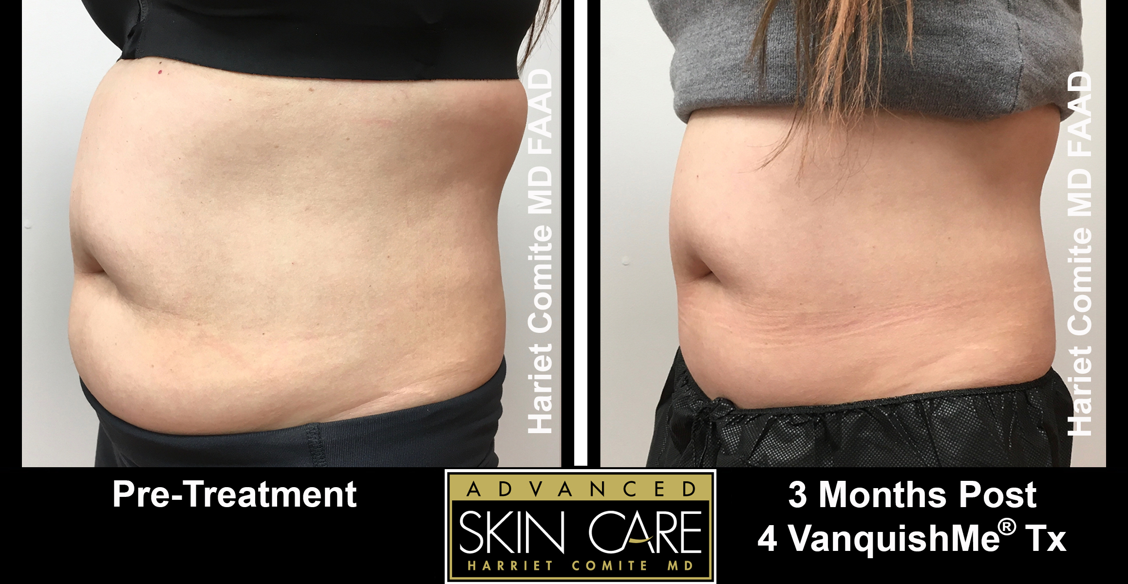 VANQUISH ME - Advanced Skin Care, Laser & Body Contouring Center