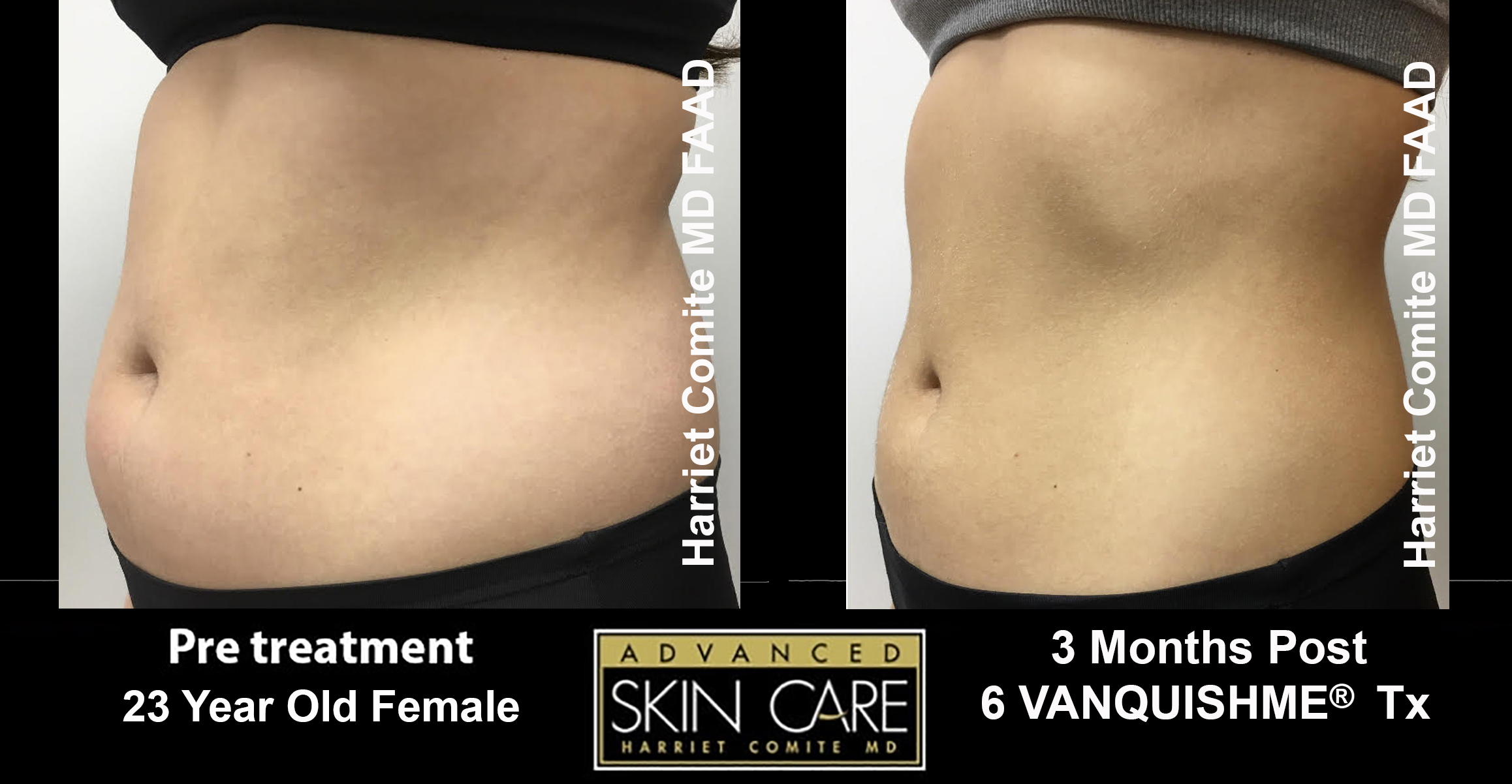 , VanquishMe Patient Before and After Gallery